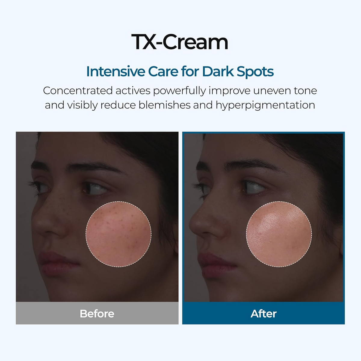 TX Skin Freckle Cream – Korean Dark Spot & Hyperpigmentation Care
