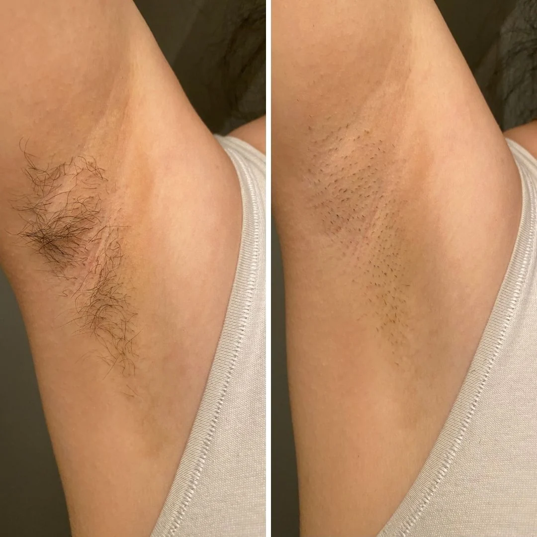 4-Head Electric Ladies Trimmer for Gentle Hair Removal