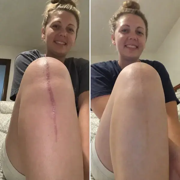 Silicone Scar Smoothing & Skin Repair Care for Scar Appearance