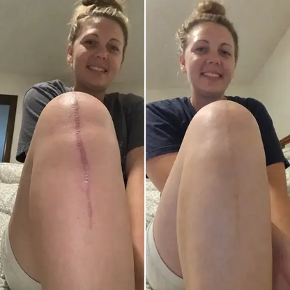 Silicone Scar Smoothing & Skin Repair Care for Scar Appearance