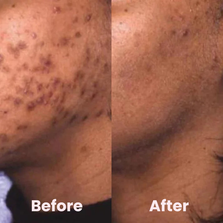 Turmeric Kojic Exfoliating Pads – Brighten, Smooth & Renew Skin Instantly